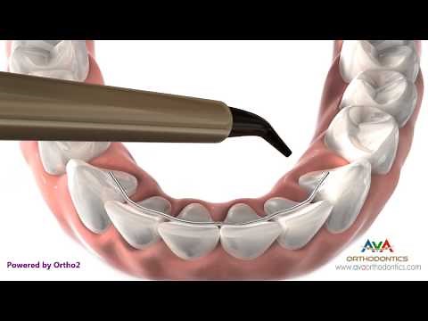 Orthodontics Retainer - Bonded or Permanent