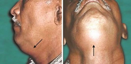 Deep neck infection causes, symptoms, diagnosis, treatment & prognosis