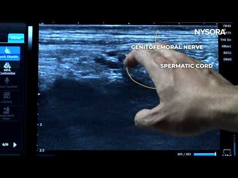 Ultrasound-Guided Genitofemoral Nerve Block NYSORA (Freemedbooks.com)