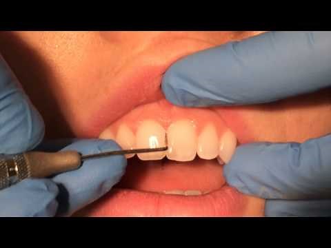 Periodontal Probing