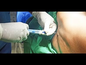 Epidural Anaesthesia - 2 | techniques | Dr.S.Parthasarathy MD.,DNB, PhD