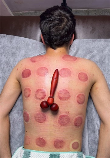 Curious About Cupping Therapy and Its Benefits?