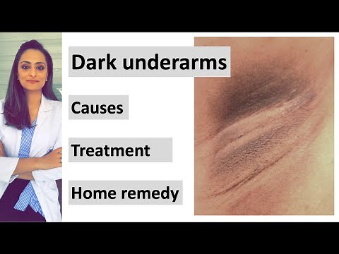 How to get rid of Dark underarms | causes| treatment| home remedy| Dermatologist | Dr. Aanchal
