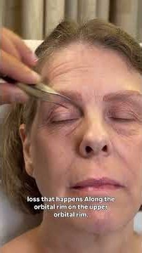 Pre-Op Plan for Tami, 55: Full Facelift Transformation