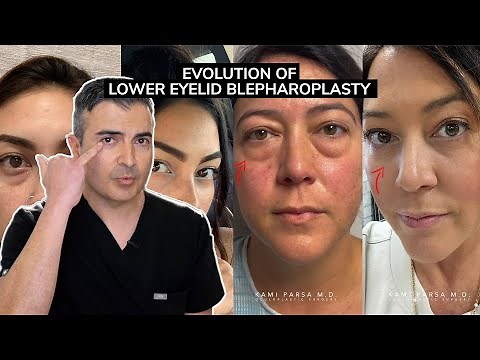 Evolution of Lower Eyelid Blepharoplasty | Dr. Parsa Explains Trifecta Lift