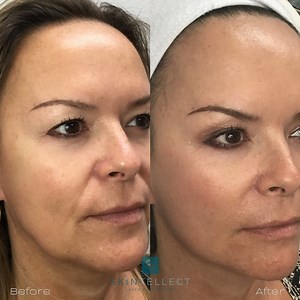 Fotona 4D Laser Facelift In Tampa | Non-Surgical Skin Tightening & Lifting