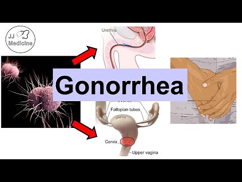 Gonorrhea (Neisseria Gonorrhea) | Pathophysiology, Symptoms & Complications, Diagnosis, Treatment