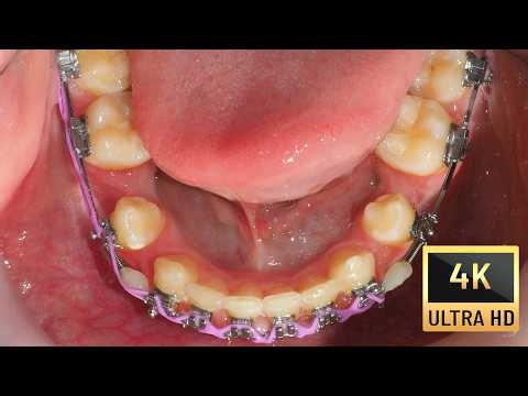 IMPLANT site development for BONE preparation in ADULTS before prosthodontic procedures! 4k