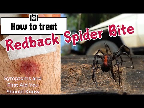 Redback Spider Bite: Symptoms and First Aid You Should Know