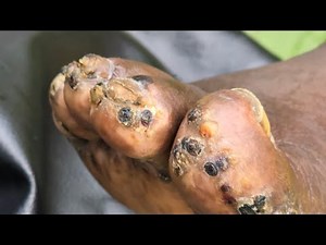 David Angote's first jigger dig - see long video @ riseupsociety.net & ruskenya.org