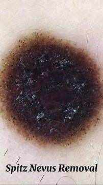 Spitz Nevus surgical removal