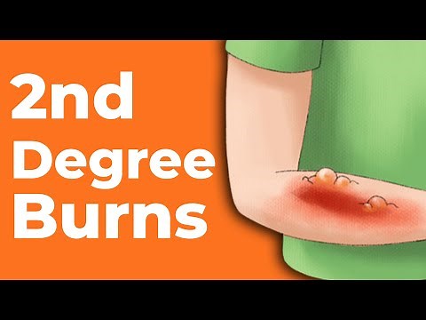 2nd Degree Burns: How to Treat Them | Wound Care OC