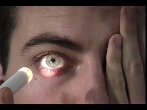 Optic nerve examination | Second cranial nerve