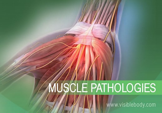 Muscular System Pathologies