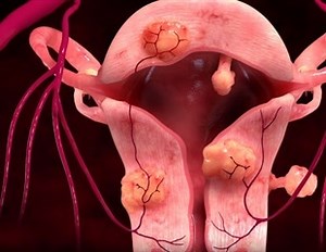 Uterine Artery Embolization: Technique and Complications