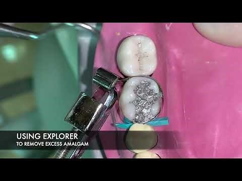 Class II Amalgam Restoration