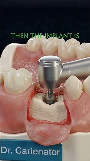 How It Works: Dental Implant Process Explained 🔩