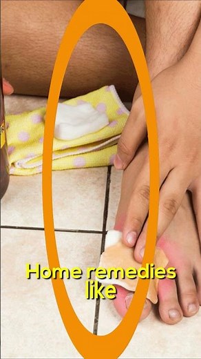 BEST Athlete's Foot Fungus Treatments [HOME Remedies + BIG SECRETS] PT2