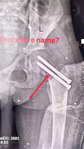 Understanding Bone Fractures: Types and Treatments
