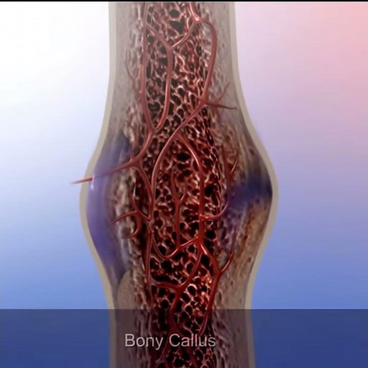 Bone Fractures: Proper Healing