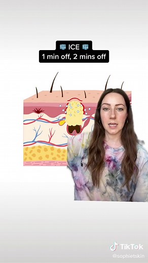 Nodular acne is a type of inflammatory acne and is found in grades 3 and 4 🔴 It feels like a solid lump under the skin - it may be skin toned or red, but either way there is no visible pus on the skin's surface and they are very tender 🔥 When people refer to 'hormonal acne', this is usually the type of acne they are experiencing. They start off in the same way as an acne papule with excess sebum, dead skin cells, the overproduction of c. acnes bacteria and inflammation. However, in nodular acn