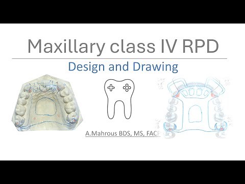 Maxillary Class IV RPD Design: Step-by-Step Guide to Surveying & Drawing on Casts and Paper