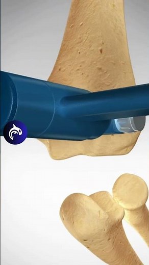 How does an Elbow Replacement work? 3D Animation