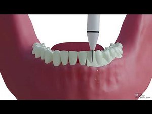 Scaling | Dental Procedures