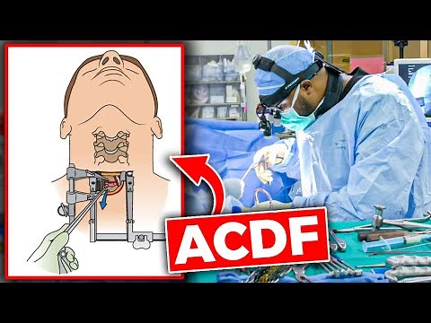 Anterior Cervical Discectomy and Fusion (ACDF)