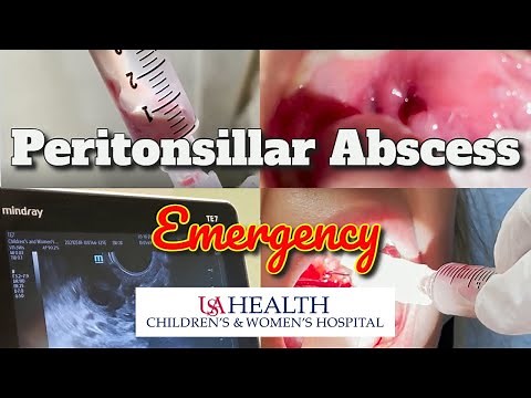 Peritonsillar Abscess Emergency and Needle Aspiration