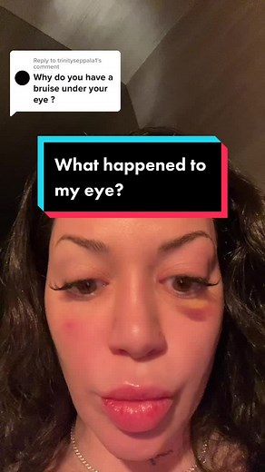 Understanding Black Eyes and Botox: Causes and Treatments