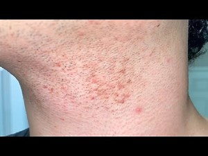 how to get rid of razor bumps on neck overnight