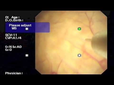 Botox therapy for Overactive Bladders