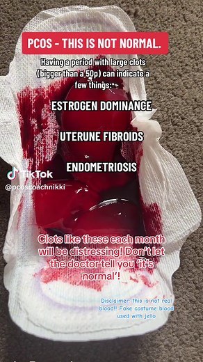 Understanding PCOS: Dealing with Big Clots During Your Period