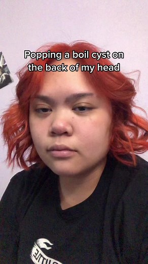 2019 Compilation of Boil Bursting and Cyst Popping | Shocking Moments