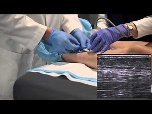 IVS Ultrasound Guided Sclerotherapy