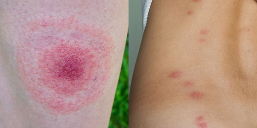 What Bit You? 17 Bug Bite Pictures to Help You ID—and Treat—Your Itch Fast