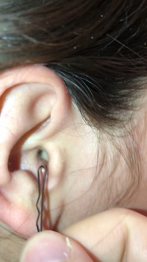 Popping an explosive in-ear zit