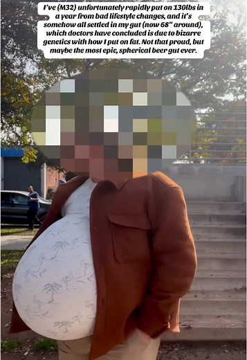 Over the past year, I’ve gained over 130 pounds, and nearly all of it has gone straight to my belly. It’s ballooned to over 68 inches around, perfectly round, heavy, and taut. Doctors are baffled—after ruling out everything from Cushing’s syndrome to thyroid issues, they’ve determined that my weight gain itself is simply caused by bad life changes (a stressful cross-country move, a bad breakup, a new sedentary job, and way too much fast food), but my genetics specifically have caused almost all 