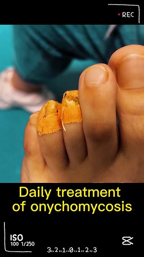 Understanding Onychomycosis: Nail Fungus Treatment Explained