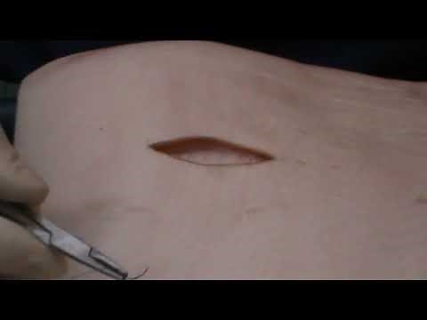 Elliptical excisions