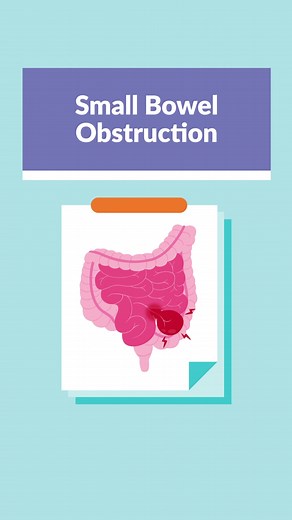 Quick Summary of Small Bowel Obstructions!💩 #smallbowel #smallbowelobstruction #bowelobstruction #peritonitis #nursing #nursingschool #nursesoftiktok