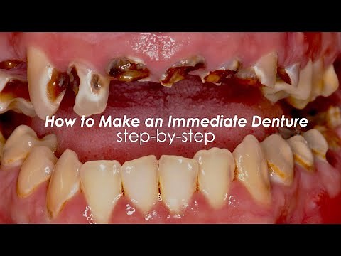 How to Make an Immediate Denture, Step-By-Step