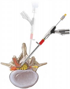 Endoscopic Decompression | Scottsdale, AZ Orthopedic Spine Surgery