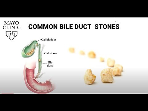 Laparoscopic Transcystic Common Bile Duct Exploration