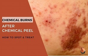 Chemical Burns After Chemical Peel - How to Spot & Treat - Sasily Skin