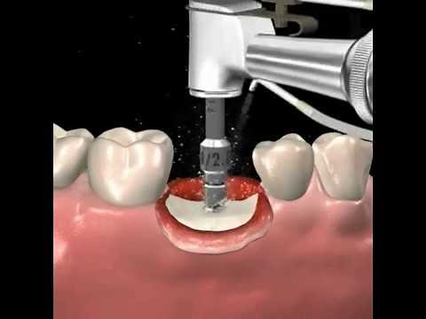 Step by step dental implant surgery. Gary R. O'Brien, D.D.S.