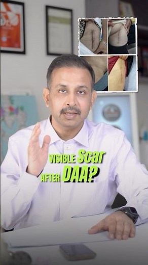 Scar after Hip Replacement (DIRECT ANTERIOR APPROACH) #directanteriorapproach #avascularnecrosis