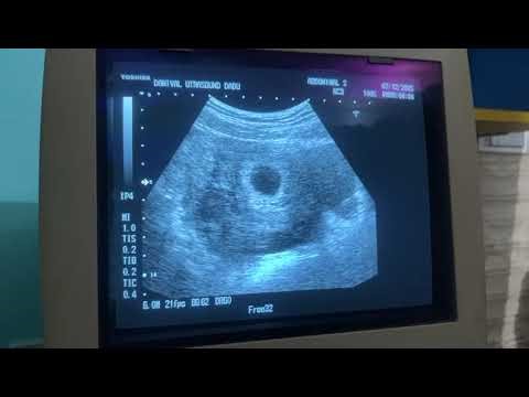Ruptured Ectopic Pregnancy | How To Diagnose | #medicaleducation #ultrasound #Medicalassociation
