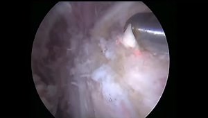 Lower Trap Transfer for Irreparable RCR